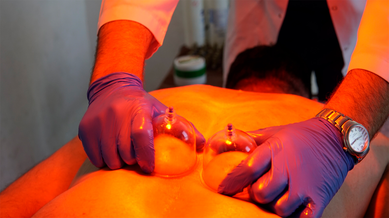 Kupa Tedavisi (Hacamat)